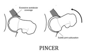 pincer